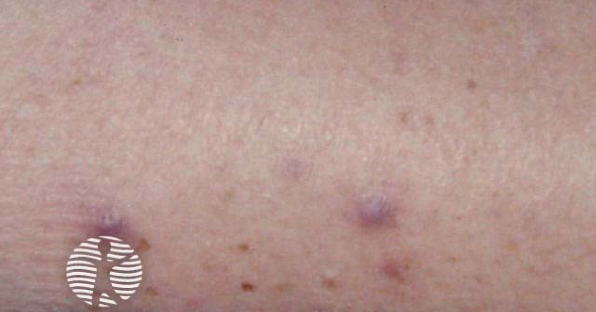Clinical image of Kaposi sarcoma