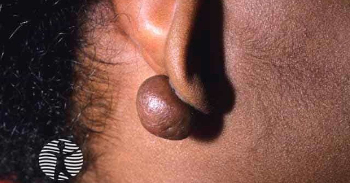 Clinical image of Keloid scar