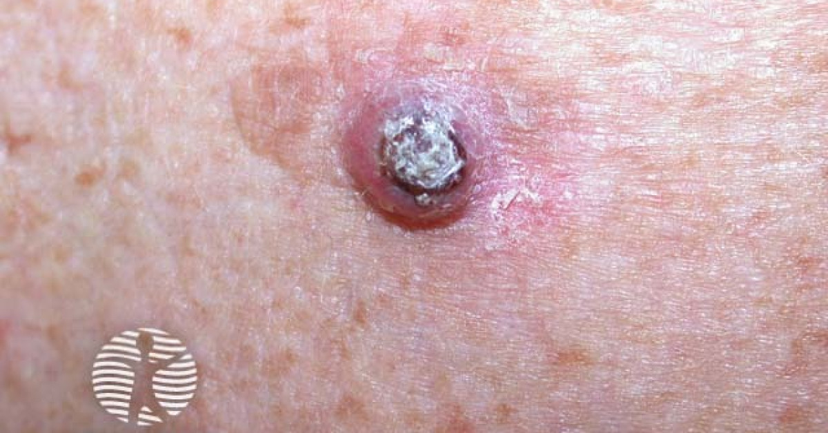Clinical image of Keratoacanthoma