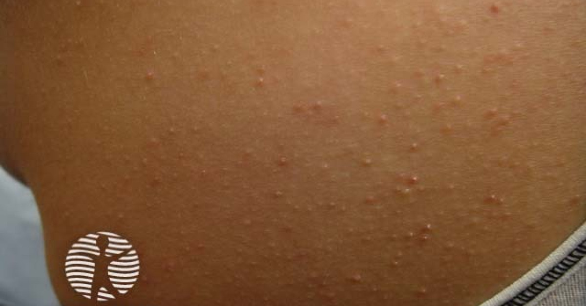 Clinical image of Keratosis pilaris