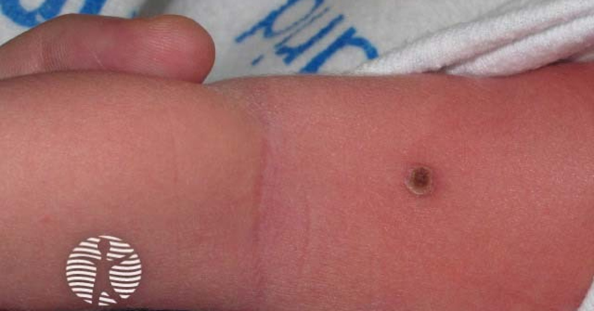 Clinical image of Langerhans cell histiocytosis