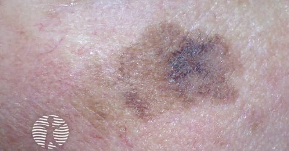 Clinical image of Lentigo maligna
