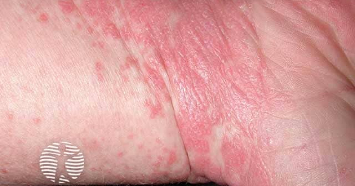 Clinical image of Lichen planus