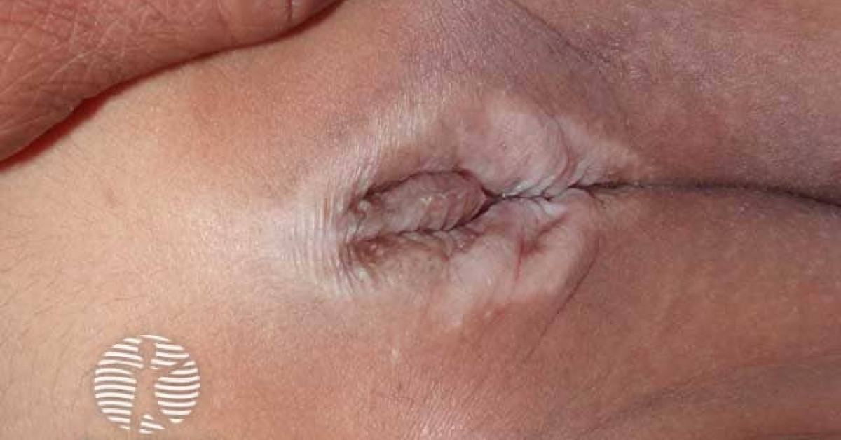 Clinical image of Lichen sclerosus