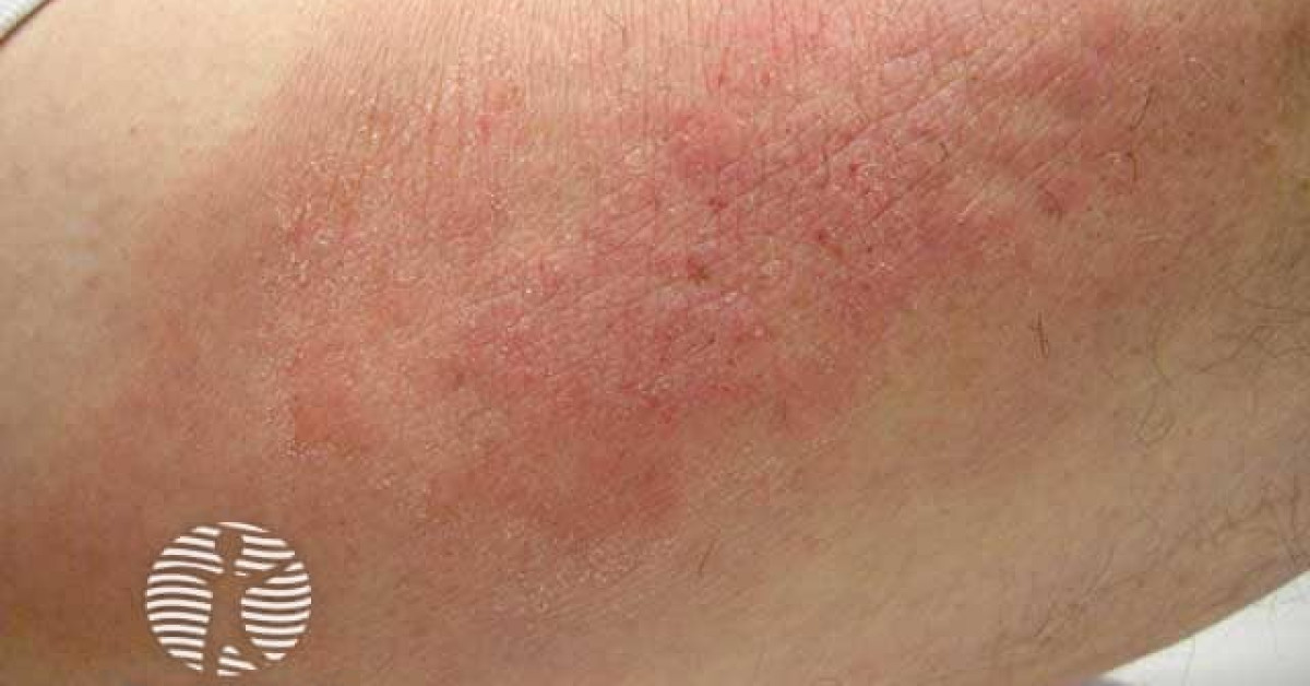Clinical image of Lichen simplex chronicus