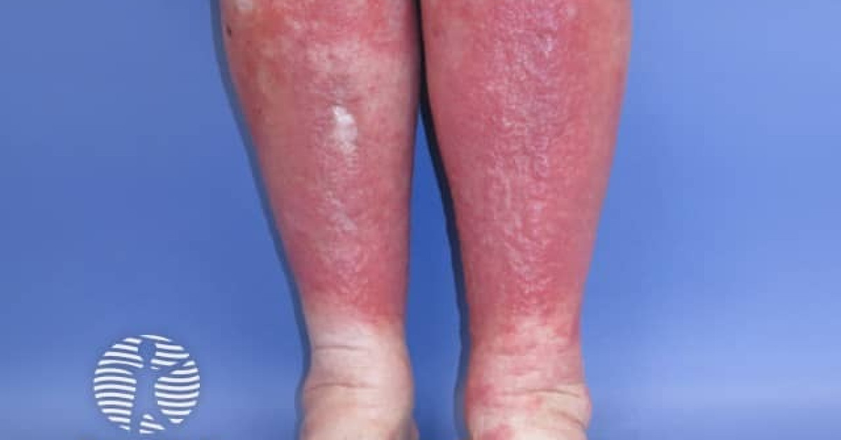 Clinical image of Lipodermatosclerosis