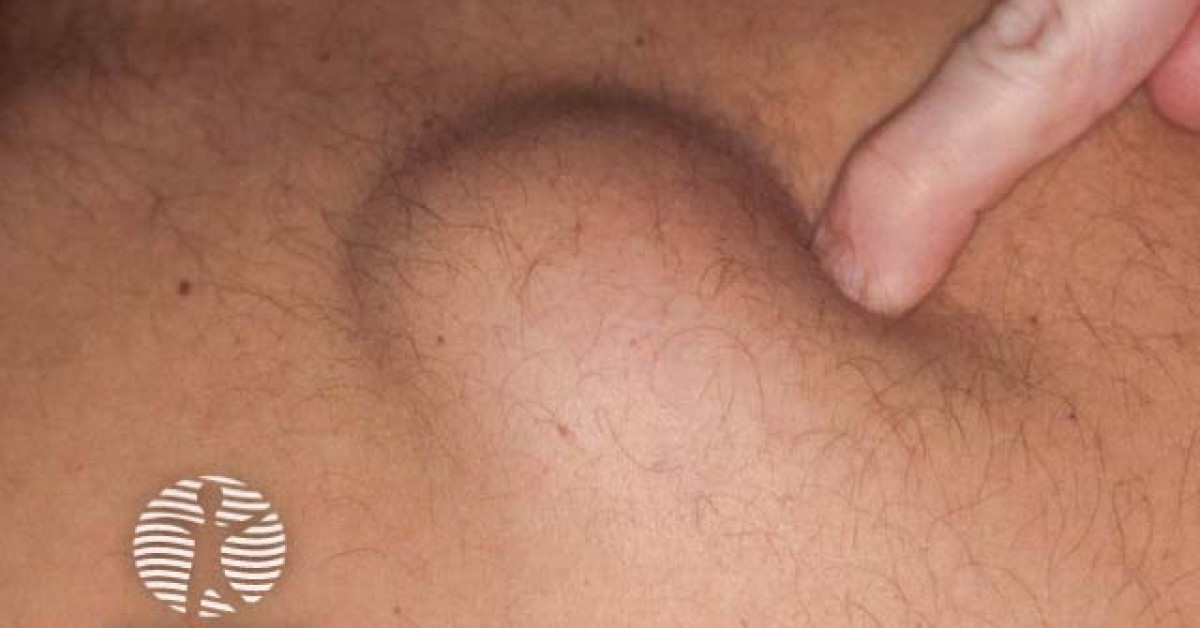 Clinical image of Lipoma