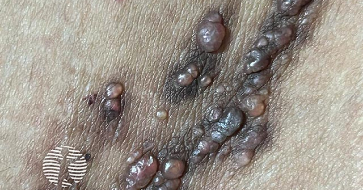 Clinical image of Lymphangioma circumscriptum