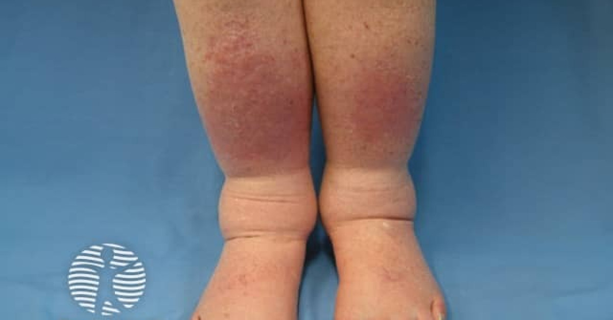 Clinical image of Lymphoedema (general overview)