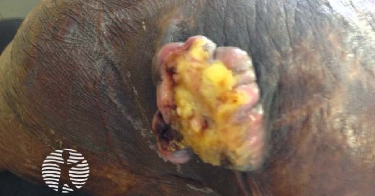 Clinical image of Marjolin's ulcer