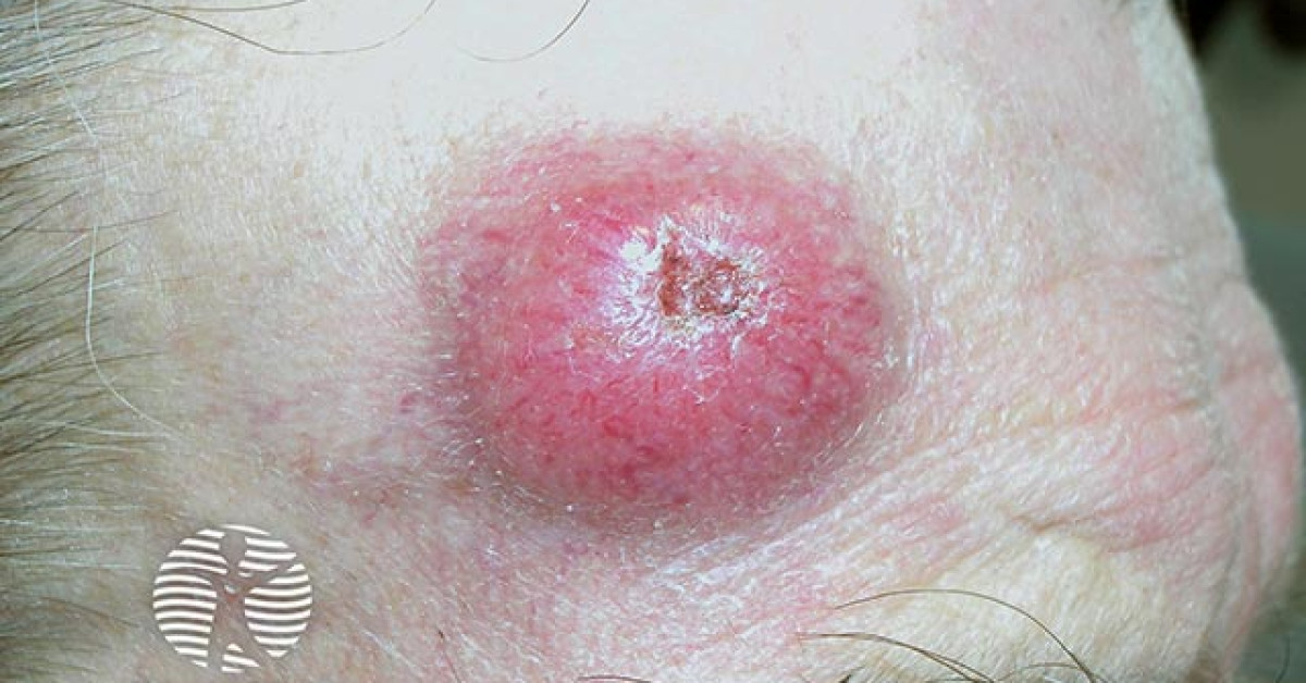 Clinical image of Merkel cell carcinoma