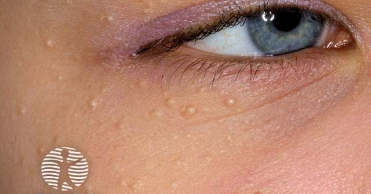 Clinical image of Milia