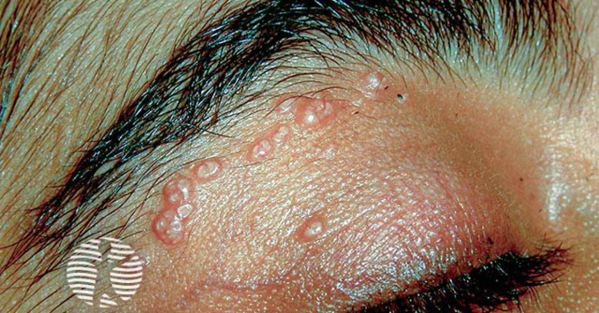 Clinical image of Molluscum contagiosum