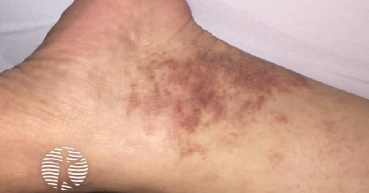 Clinical image of Mycosis fungoides