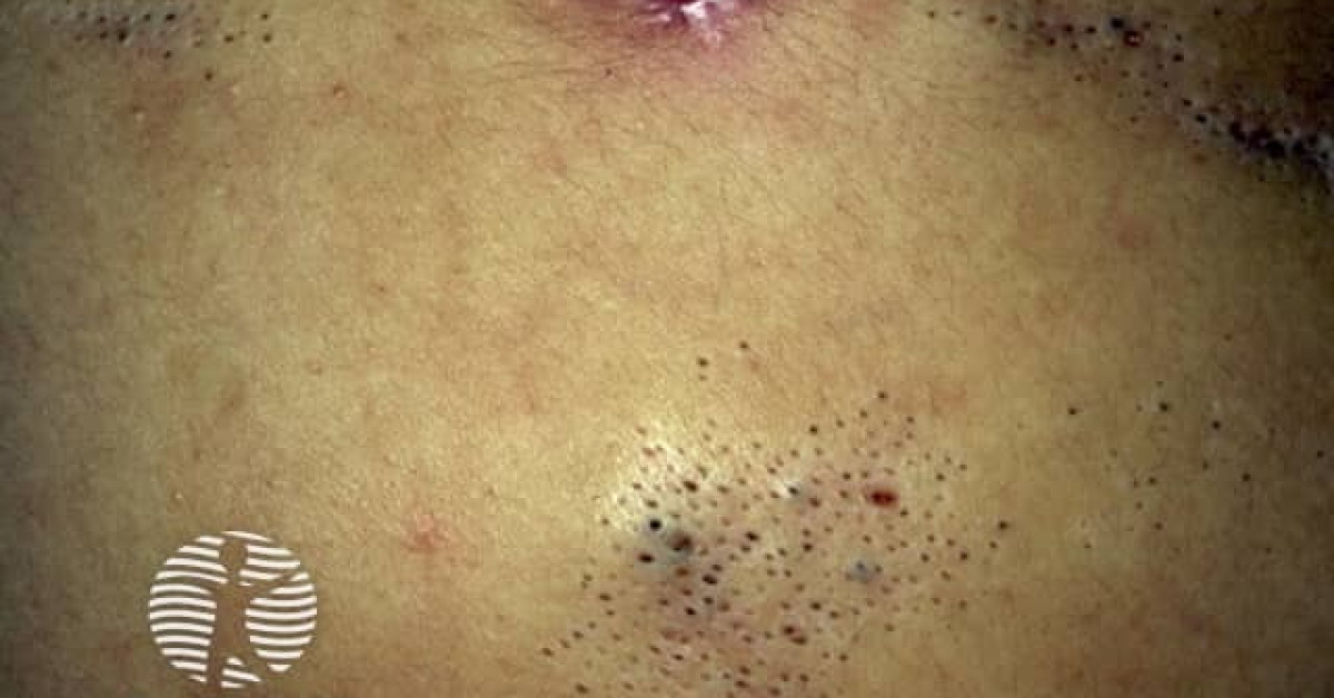 Clinical image of Naevus comedonicus