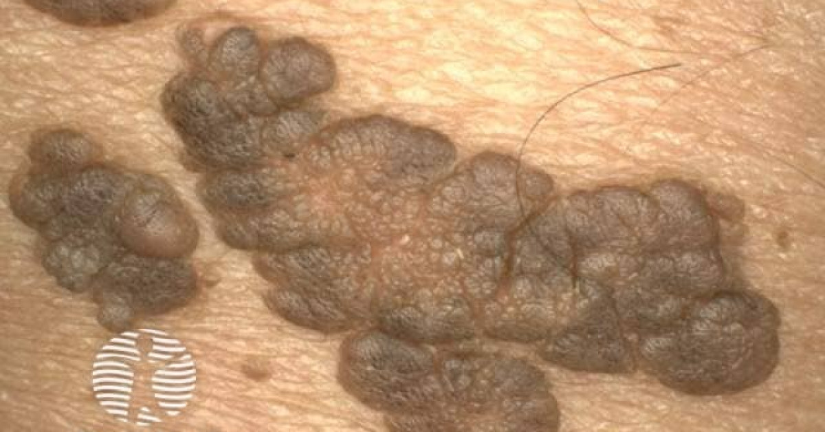 Clinical image of Naevus lipomatosus superficialis