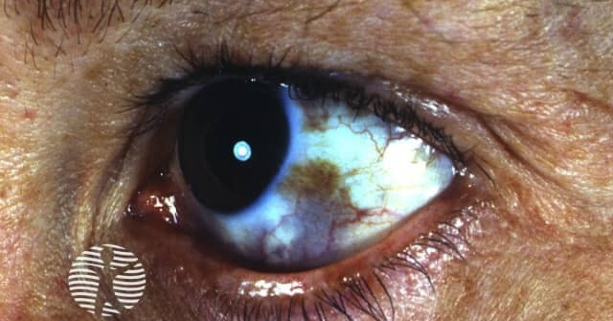 Clinical image of Naevus of Ota