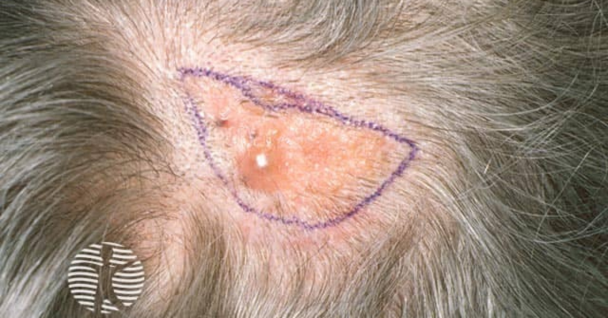 Clinical image of Naevus sebaceus of Jadassohn