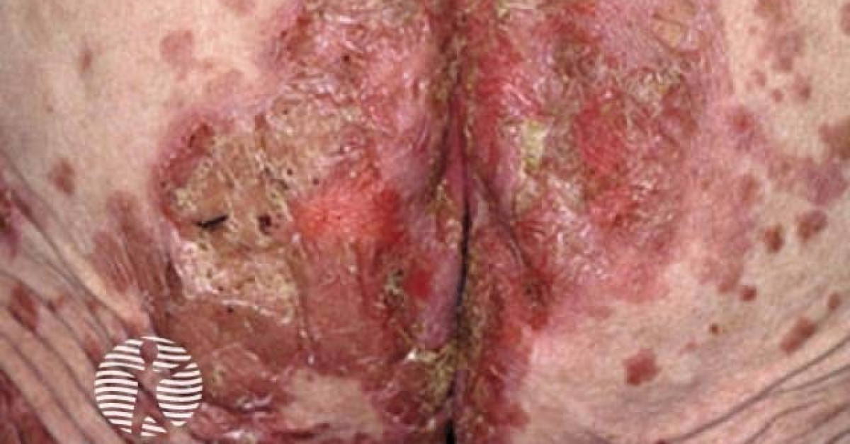 Clinical image of Necrolytic migratory erythema