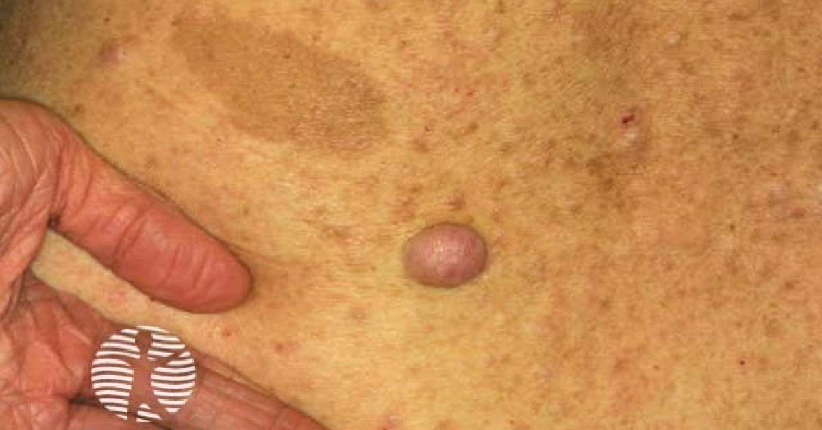 Clinical image of Neurofibromatosis 1