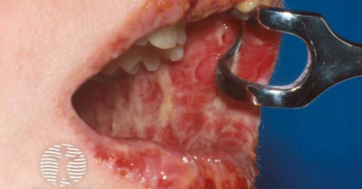 Clinical image of Paraneoplastic pemphigus
