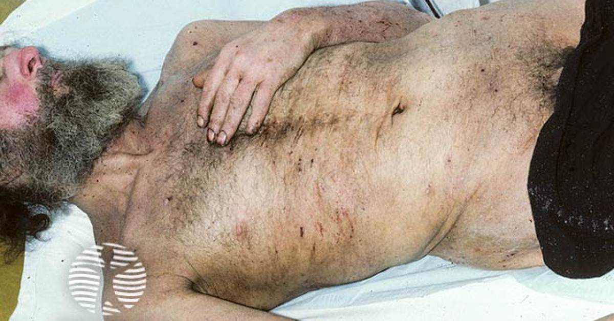 Clinical image of Pediculosis (head, body, pubic)