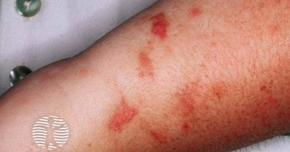 Clinical image of Phytophotodermatitis