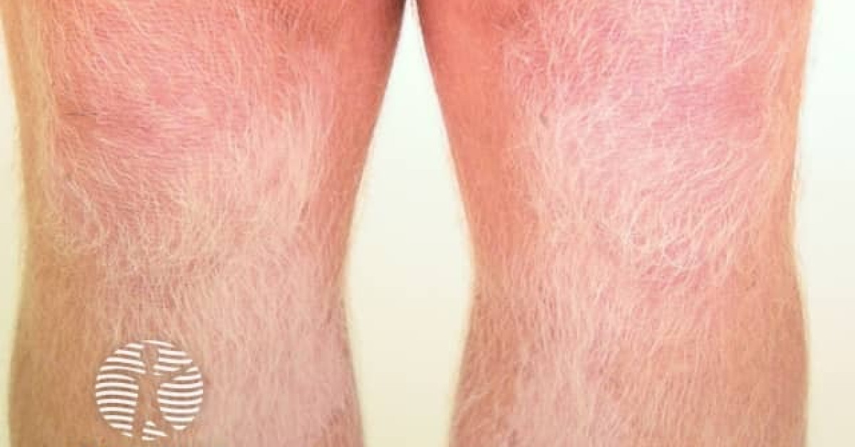 Clinical image of Piebaldism