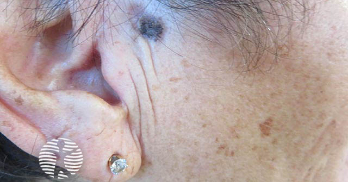 Clinical image of Pigmented BCC