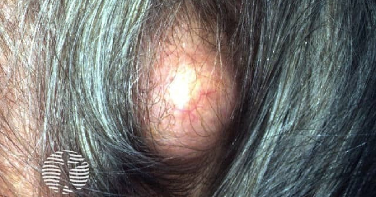 Clinical image of Pilar (trichilemmal) cyst