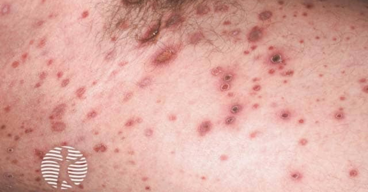 Clinical image of Pityriasis lichenoides (PLC / PLEVA)