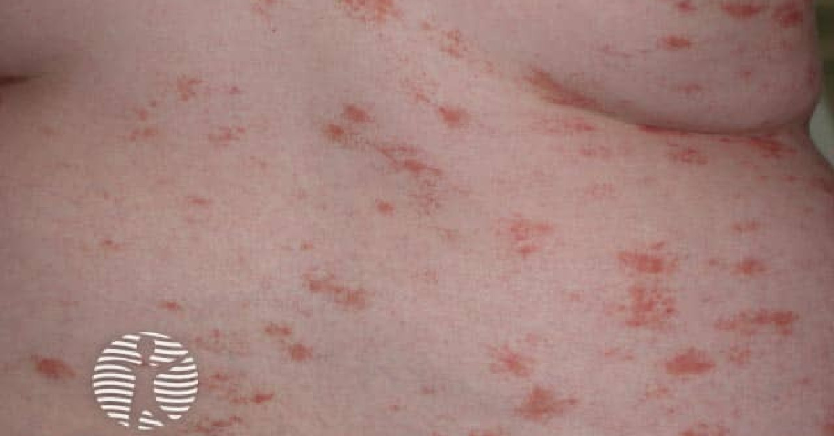 Clinical image of Pityriasis rosea