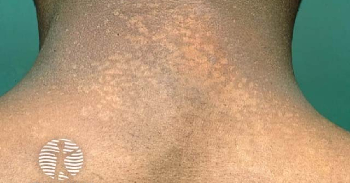 Clinical image of Pityriasis versicolor