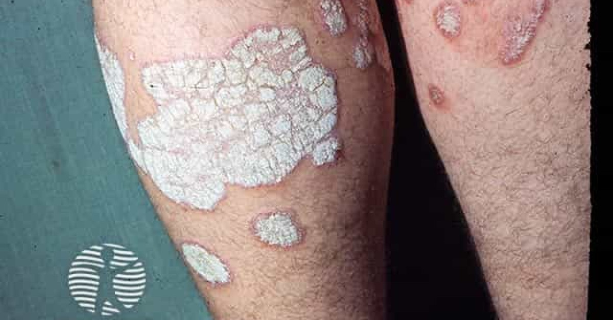 Clinical image of Plaque psoriasis