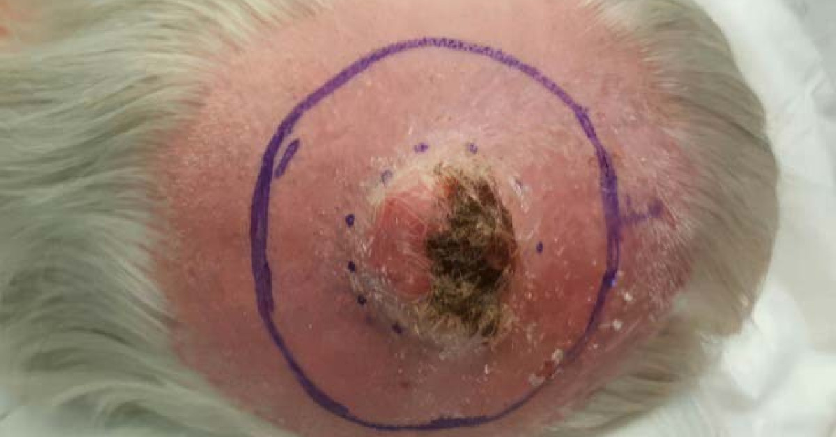 Clinical image of Pleomorphic dermal sarcoma