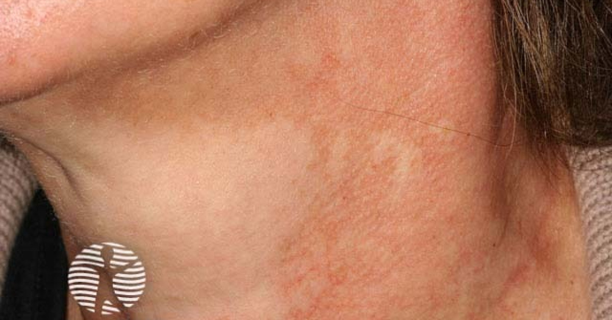 Clinical image of Poikiloderma of Civatte
