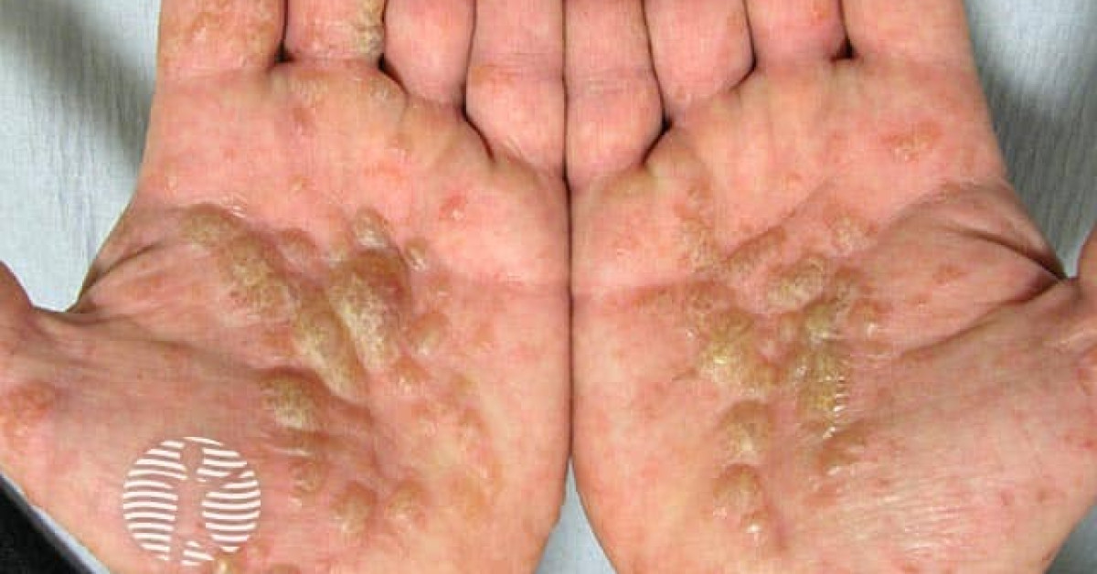 Clinical image of Pompholyx (dyshidrotic eczema)