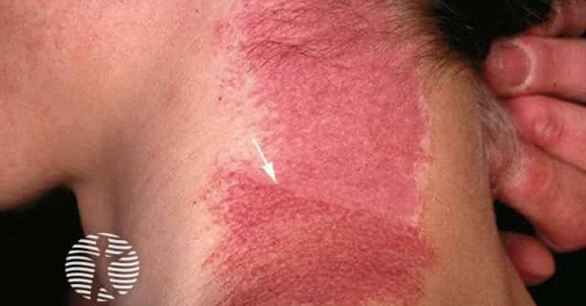 Clinical image of Port-wine stain