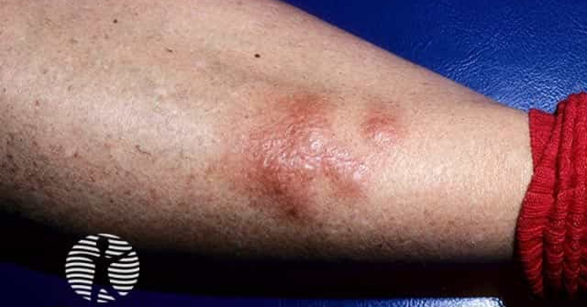 Clinical image of Pretibial myxoedema