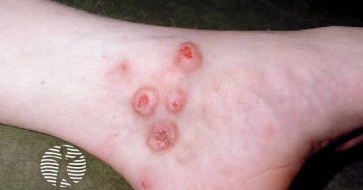 Clinical image of Prurigo nodularis