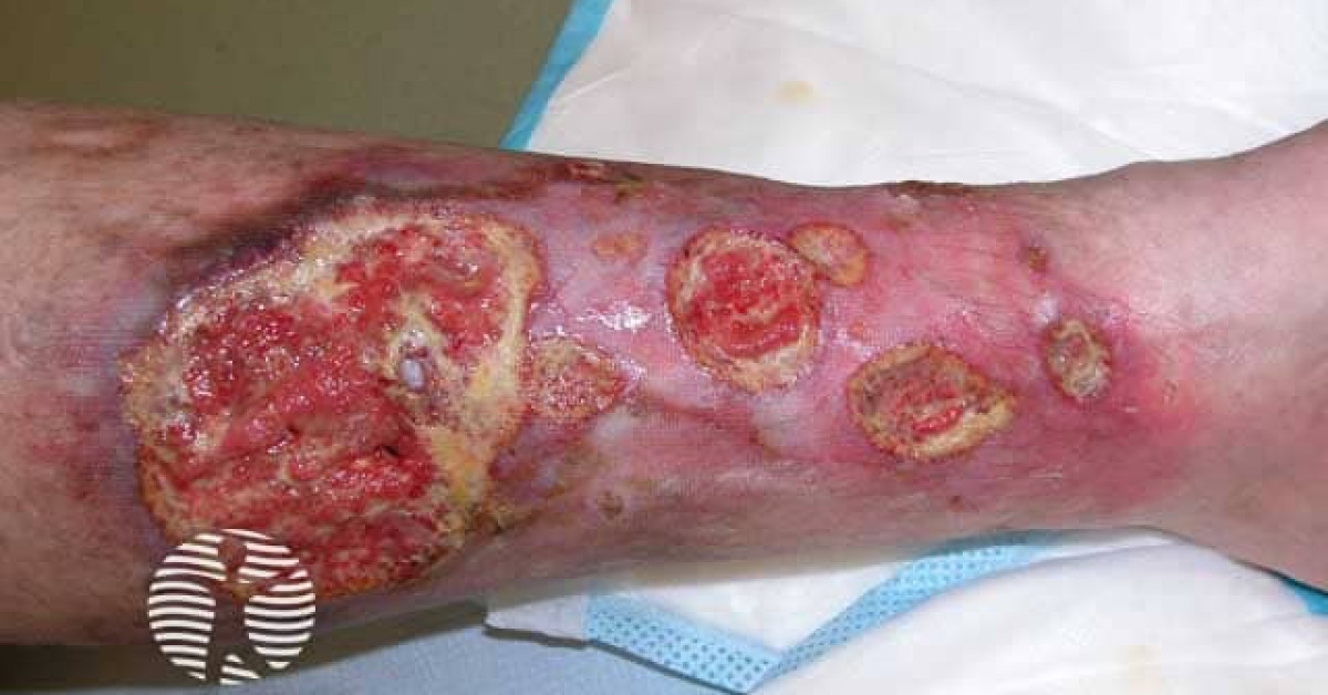 Clinical image of Pyoderma gangrenosum