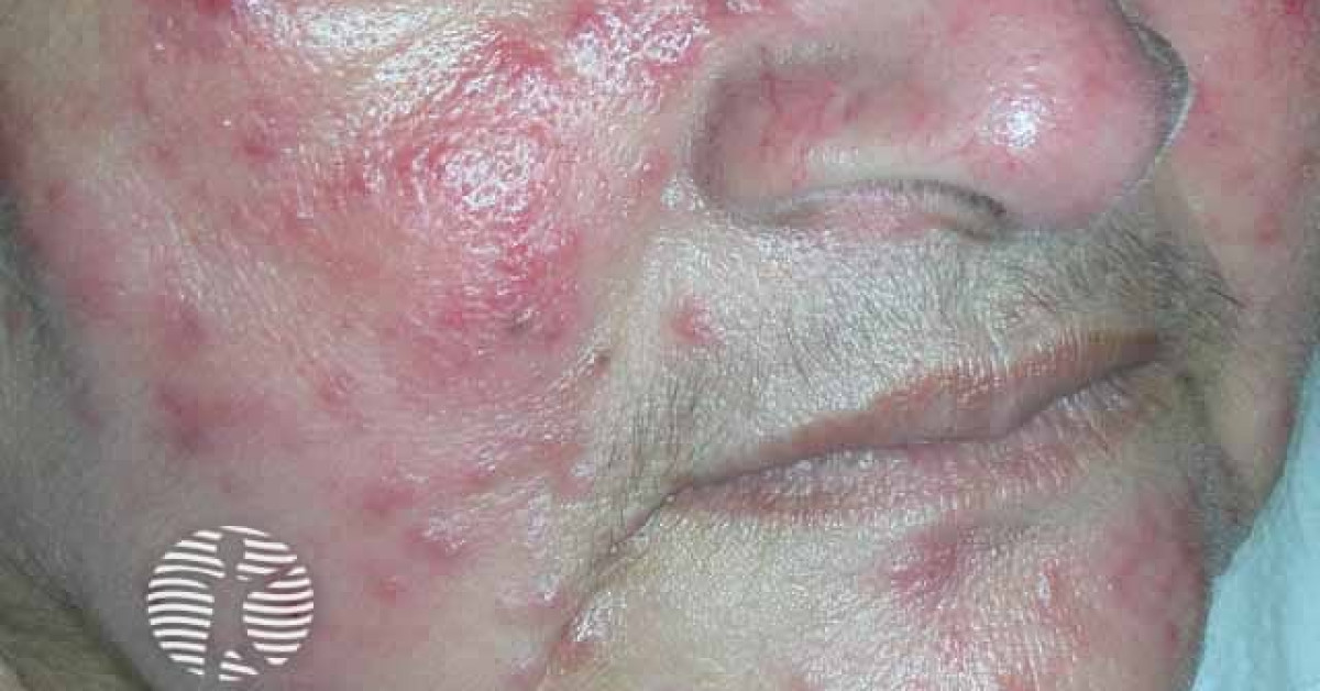 Clinical image of Rosacea