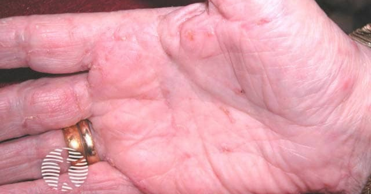 Clinical image of Scabies (including crusted)