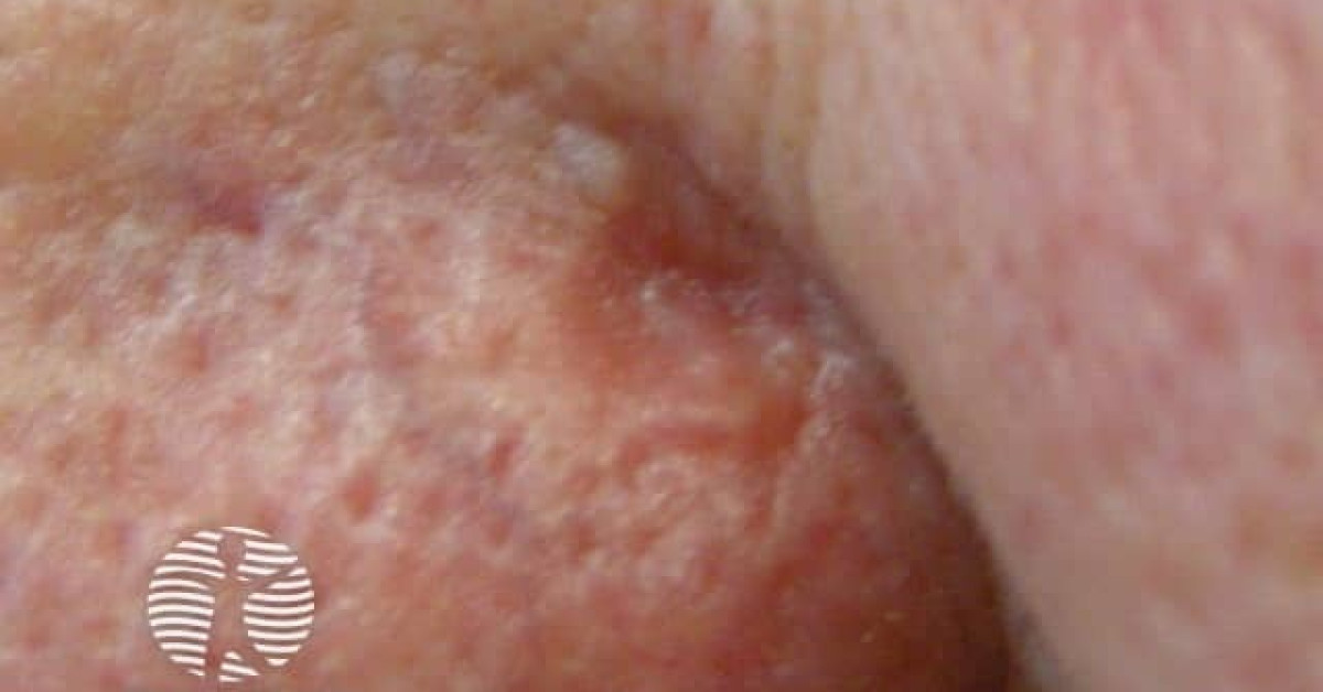 Clinical image of Sebaceous carcinoma