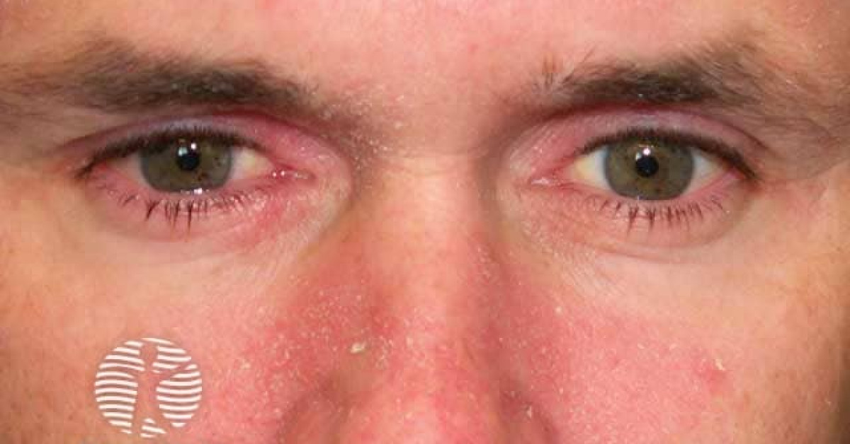 Clinical image of Seborrhoeic dermatitis