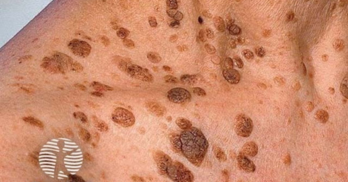 Clinical image of Seborrhoeic keratosis
