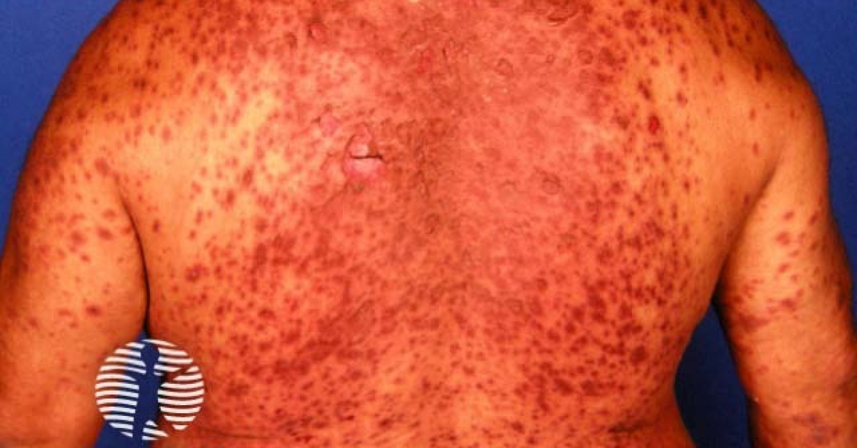 Clinical image of Stevens-Johnson syndrome / TEN