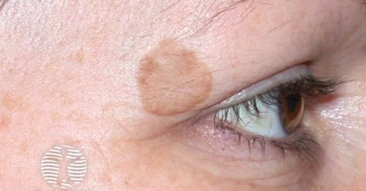 Clinical image of Solar lentigo