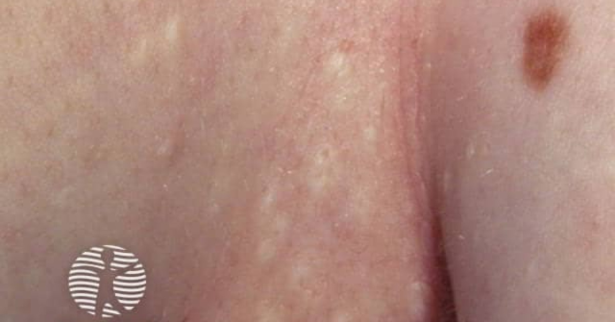 Clinical image of Steatocystoma multiplex