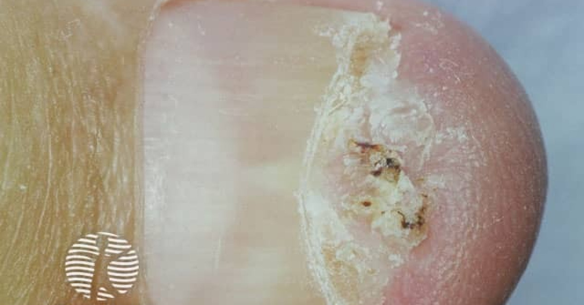 Clinical image of Subungual squamous cell carcinoma
